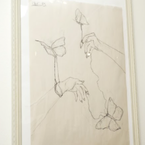 Arthrogrposis by Chelsea Ochoa